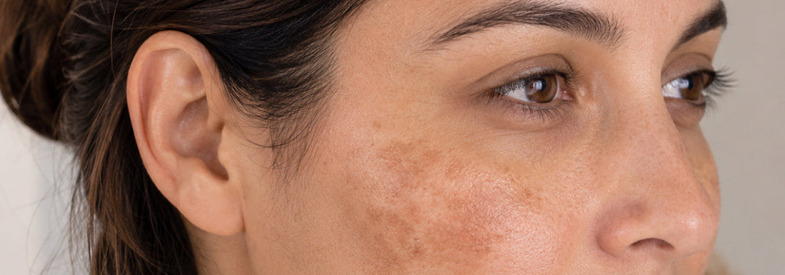 Pregnancy and Melasma: Managing the Mask of Pregnancy