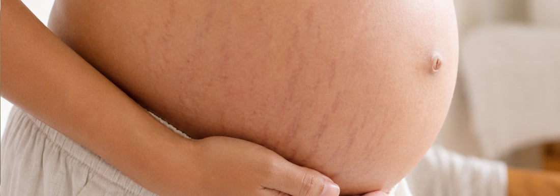 Stretch Marks During Pregnancy: What the Evidence Actually Says